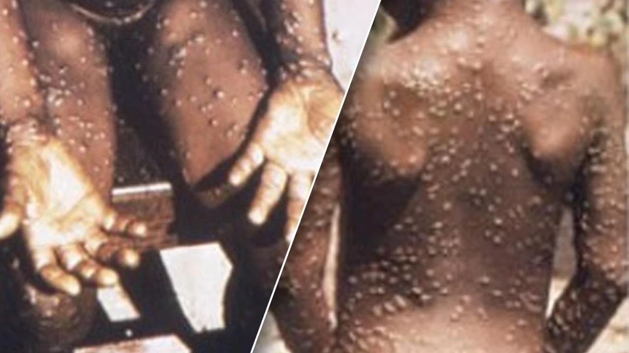 หมอยง ชี้ "ฝีดาษลิง" ไม่ใช่โรคอุบัติใหม่ ยังไม่พบในไทย พร้อมแนะทางป้องกัน