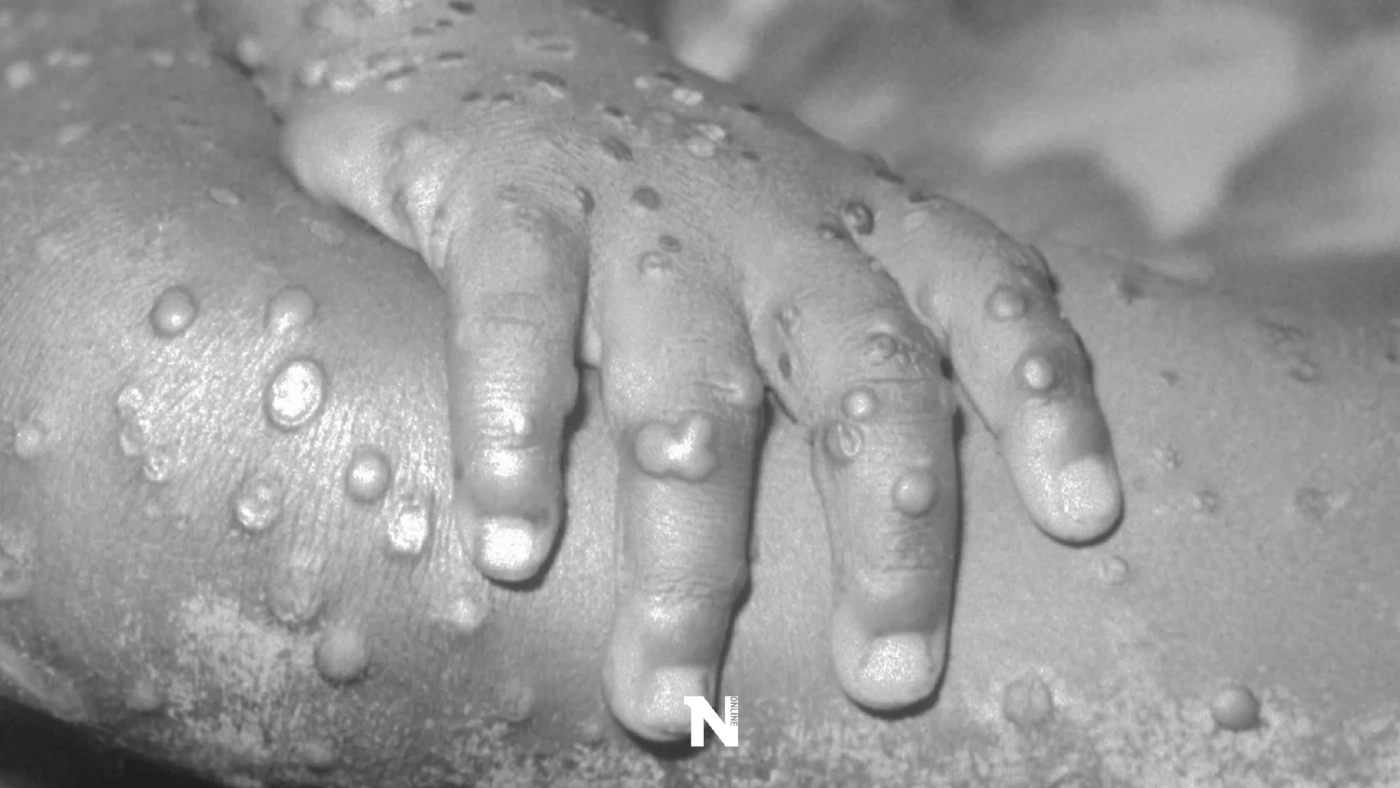 อ.เจษฎา ชี้ ไทยมีโอกาสเจอ โรคฝีดาษลิง แต่ถือเป็นโรคไม่น่าเป็นห่วงมากนัก