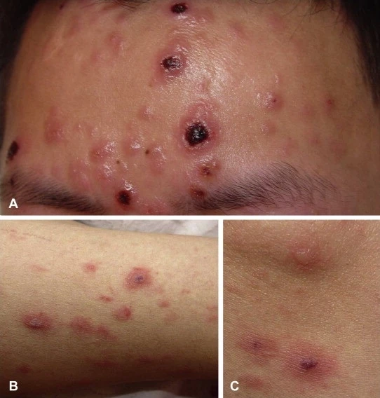 ระวัง!!“โรคซิฟิลิส”โรคร้ายติดได้..แม้ไม่ได้มีเพศสัมพันธ์