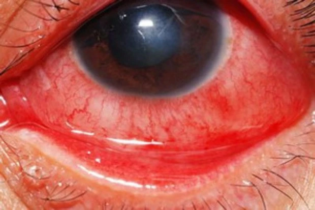 หมอเตือน ระวัง"โรคตาแดง" พบระบาดหนักในช่วงหน้าฝน