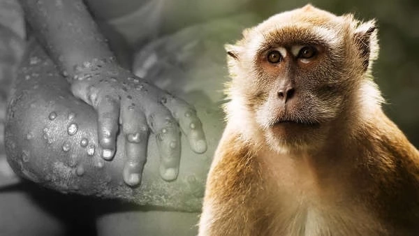 "โรคฝีดาษลิง" คืออะไร? ล่าสุดพบผู้ติดเชื้อในสหรัฐฯ-อังกฤษ