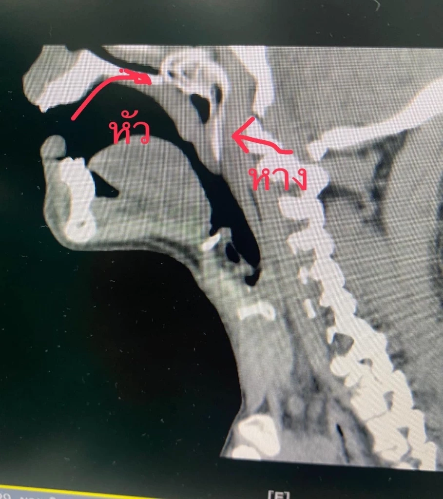 สยอง !! "ปลาหมอ" เข้าปากติดลำคอคนหาปลา แพทย์โรงพยาบาลพัทลุงช่วยผ่าจนรอดตาย