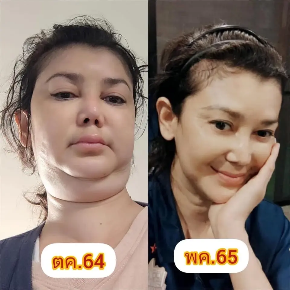 แทบเอาชีวิตไม่รอด "เอ๋ อัจฉรา" เล่าหลังจากรอดตาย หัวใจ-ไตวายเฉียบพลัน