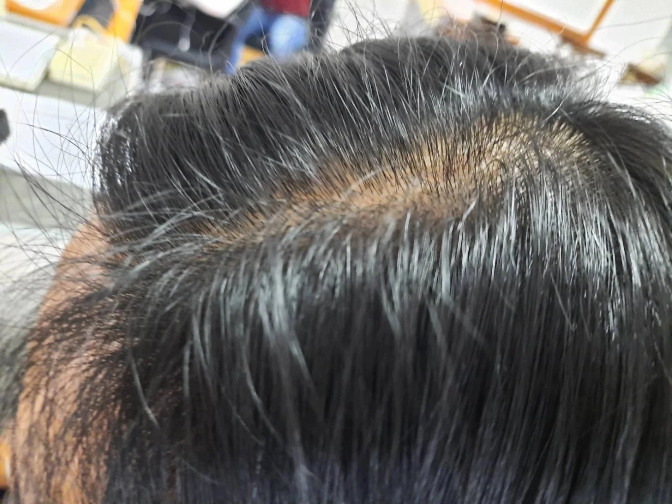 ผมร่วงหลังติดโควิด เกิดขึ้นได้อย่างไร  แพทย์ผิวหนังมีคำตอบ พร้อมวิธีรักษา