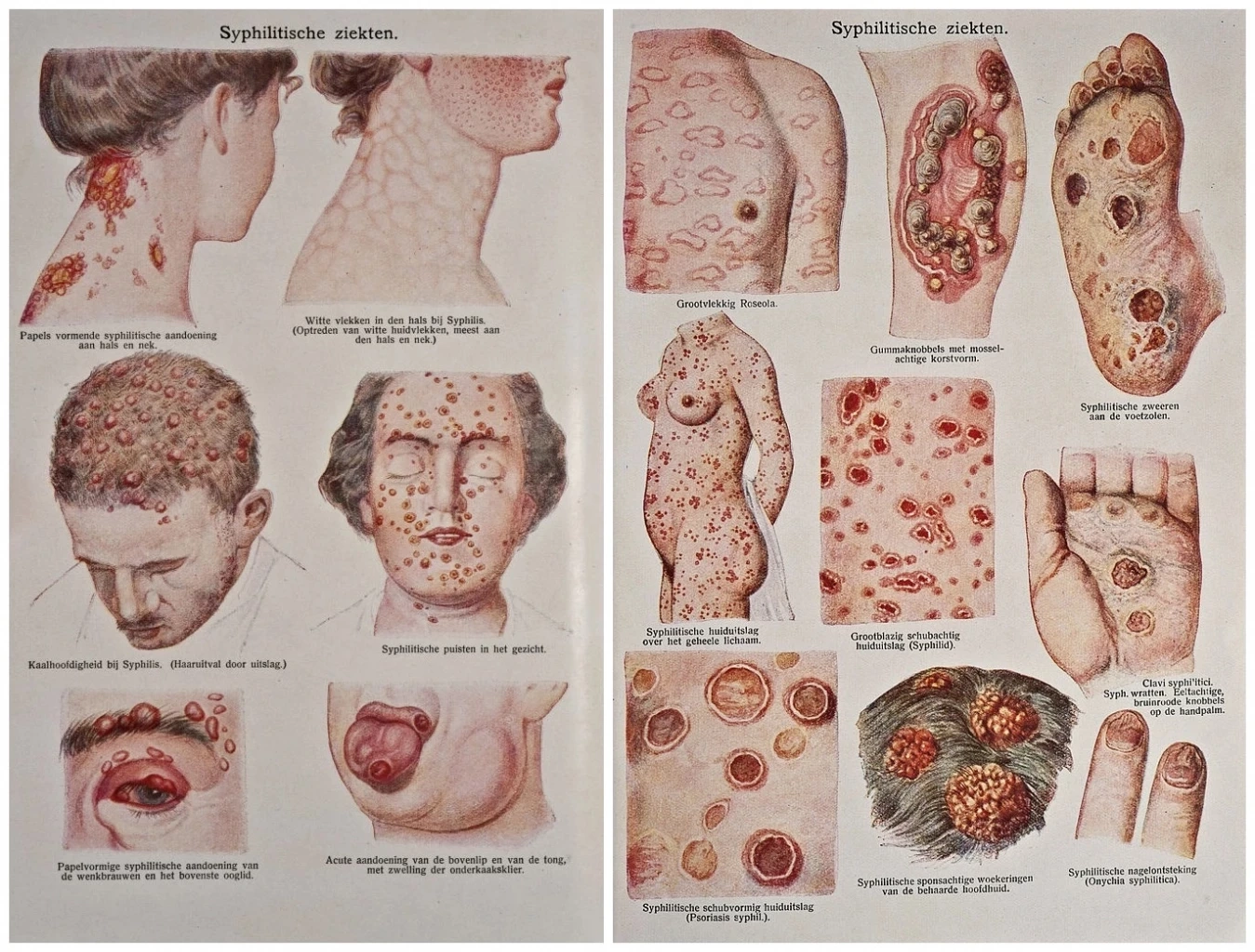 ระวัง!!“โรคซิฟิลิส”โรคร้ายติดได้..แม้ไม่ได้มีเพศสัมพันธ์