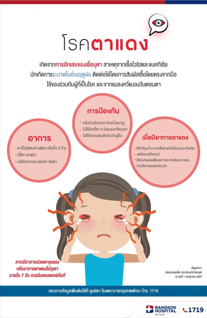 หมอเตือน ระวัง"โรคตาแดง" พบระบาดหนักในช่วงหน้าฝน