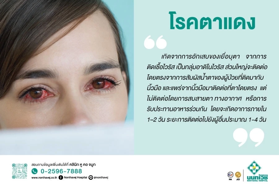 หมอเตือน ระวัง"โรคตาแดง" พบระบาดหนักในช่วงหน้าฝน