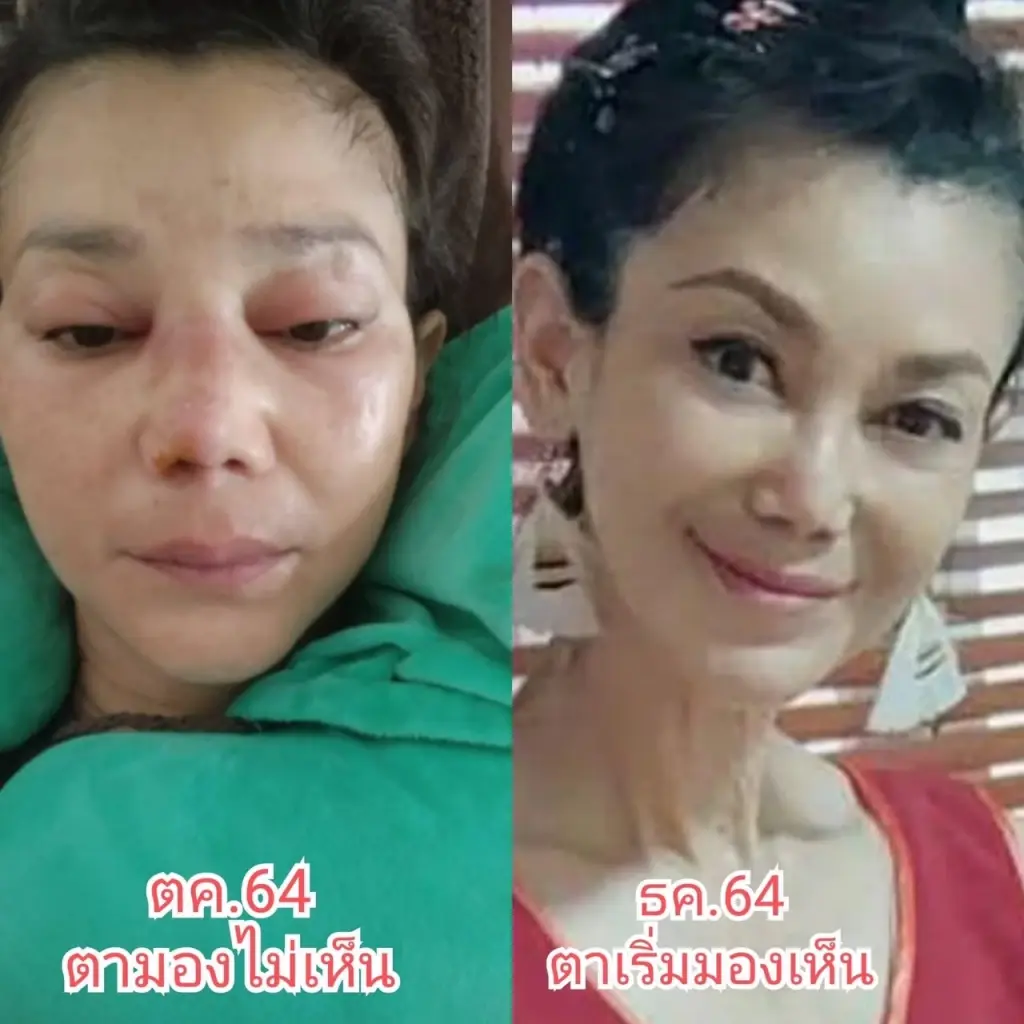 แทบเอาชีวิตไม่รอด "เอ๋ อัจฉรา" เล่าหลังจากรอดตาย หัวใจ-ไตวายเฉียบพลัน