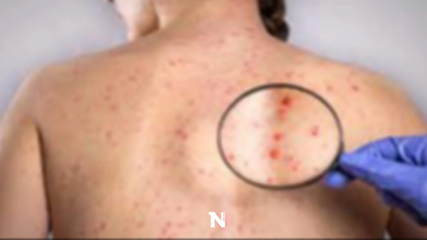 ระวัง!!“โรคซิฟิลิส”โรคร้ายติดได้..แม้ไม่ได้มีเพศสัมพันธ์