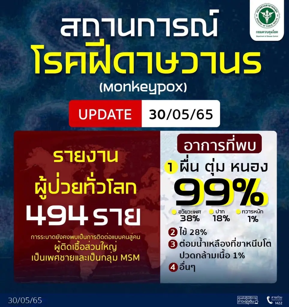 กรมควบคุมโรค เปิดนิยาม “ผู้ป่วยสงสัย-ผู้เข้าข่าย-ผู้ป่วยยืนยัน” ฝีดาษลิง