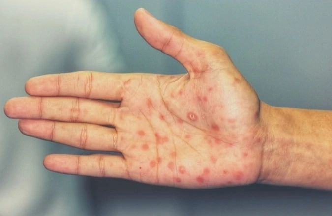 ระวัง!!“โรคซิฟิลิส”โรคร้ายติดได้..แม้ไม่ได้มีเพศสัมพันธ์