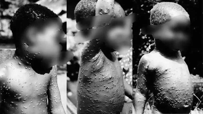 หมอธีระวัฒน์ เผย 7 ความแปลก "ฝีดาษลิง" ในยุคปลายโควิด ย้ำต้องเฝ้าติดใกล้ชิด