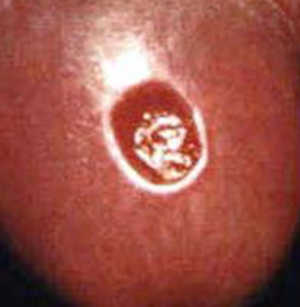 ระวัง!!“โรคซิฟิลิส”โรคร้ายติดได้..แม้ไม่ได้มีเพศสัมพันธ์