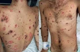 ระวัง!!“โรคซิฟิลิส”โรคร้ายติดได้..แม้ไม่ได้มีเพศสัมพันธ์