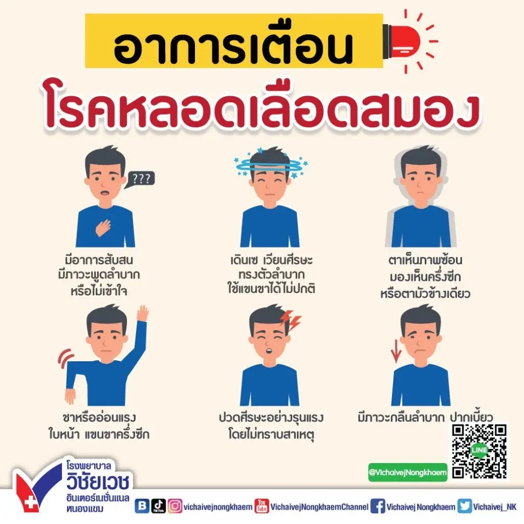 เตือนภัยเงียบของ ‘โรคหลอดเลือดสมอง’ อันตรายมากกว่าที่คิด