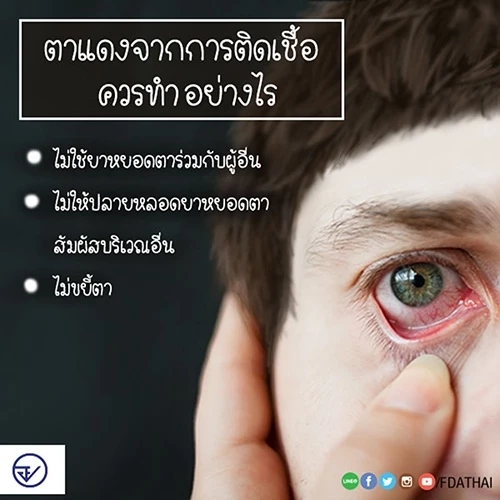 หมอเตือน ระวัง"โรคตาแดง" พบระบาดหนักในช่วงหน้าฝน