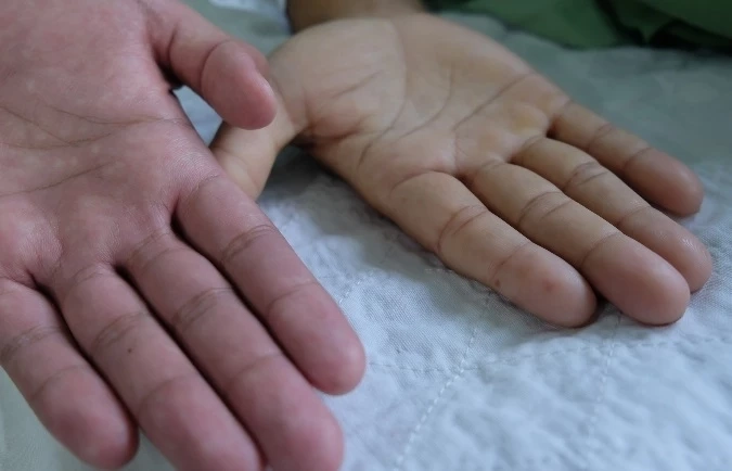 "ธาลัสซีเมีย" โรคทางพันธุกรรมที่(เราทุกคน)ป้องกันได้