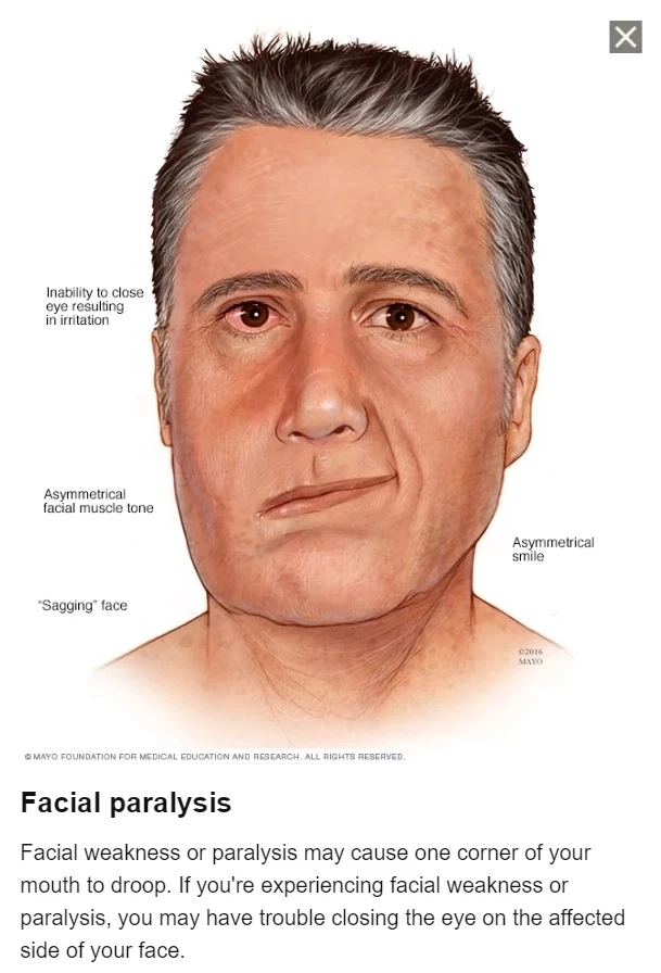 ขอขอบคุณเครดิตภาพจาก Mayo Clinic