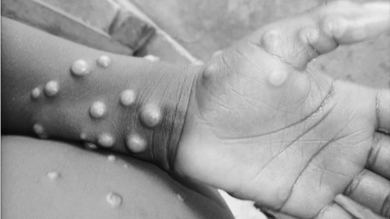 เวเนซุเอลายืนยันพบผู้ป่วย 'โรคฝีดาษลิง' รายแรก กลับจากสเปน