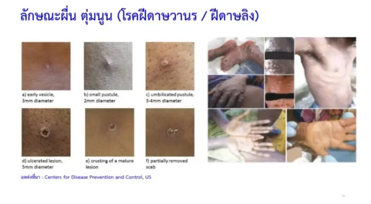 ภาพอาการฝีดาษลิงในมนุษย์