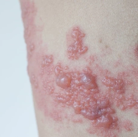 ทำความรู้จักโรคงูสวัด อันตรายสักแค่ไหน ติดเชื้อได้ทางไหนกันบ้าง