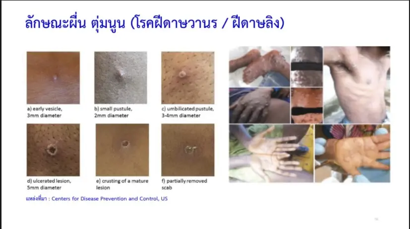 สธ. เผย ทั่วโลกพบผู้ป่วยยืนยัน “โรคฝีดาษลิง” 920 คน ใน 43 ประเทศ