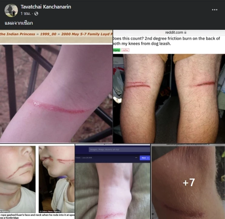 “หมอธวัชชัย” โพสต์ภาพ “แผลจากเชือก” เทียบชัดแผลก้างปลา “แตงโม”