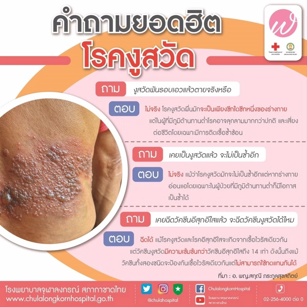 ทำความรู้จักโรคงูสวัด อันตรายสักแค่ไหน ติดเชื้อได้ทางไหนกันบ้าง