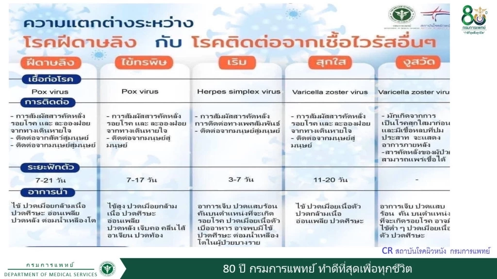 เช็กชัวร์ "ฝีดาษลิง" อาการแบบไหน แสดงว่าติดเชื้อไวรัสฝีดาษแล้ว!!