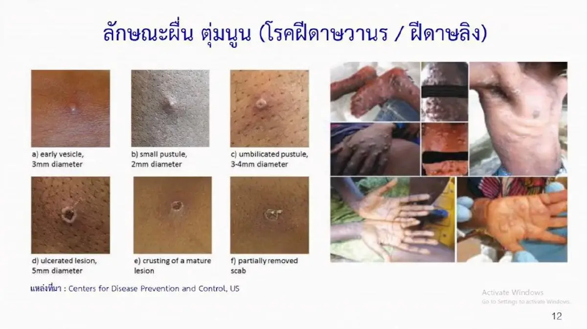 เปิด 9 มาตรการรับมือ "ฝีดาษลิง" เผย 7 หลีกเลี่ยง 2 ควรทำ หลักการง่ายๆ ทำได้ทุกคน!