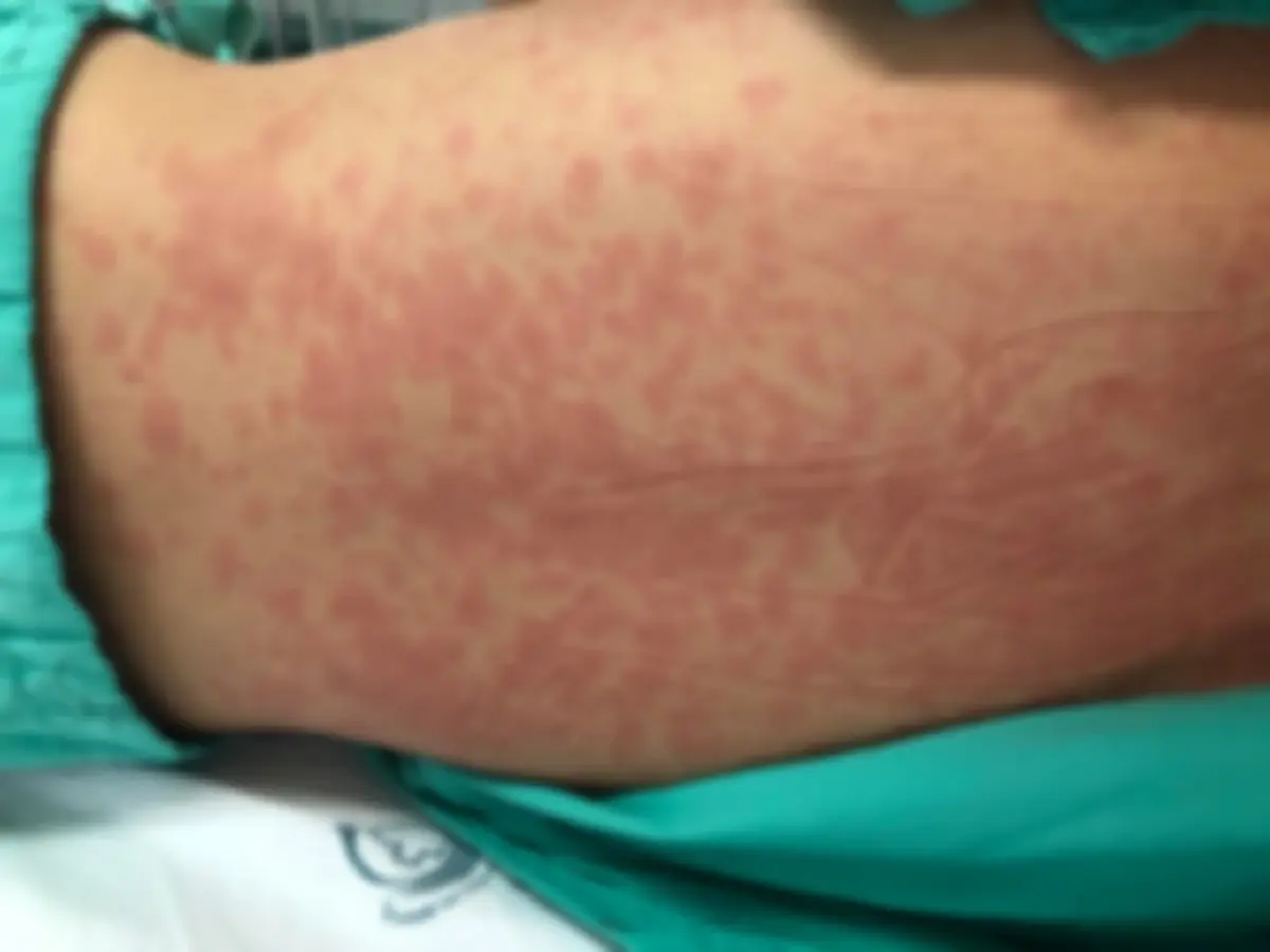 ทำความรู้จัก ภาวะมิสซี (MIS-C) อาการอักเสบในเยาวชนติดโควิด อันตรายถึงชีวิต
