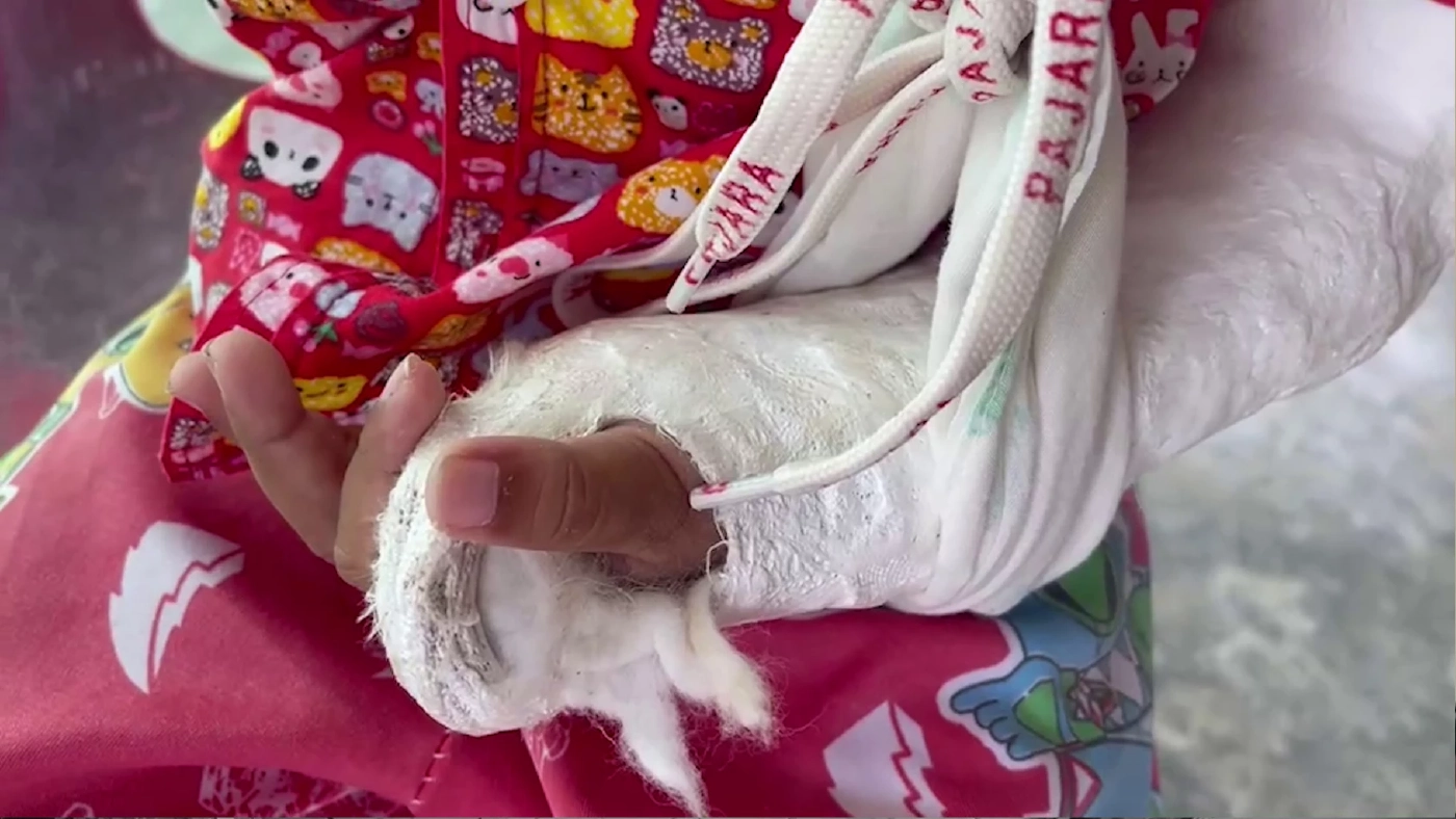 อาช็อคหลาน 5 ขวบแขนหักกลับบ้านครูไม่สนเบี้ยวค่าเยียวยา