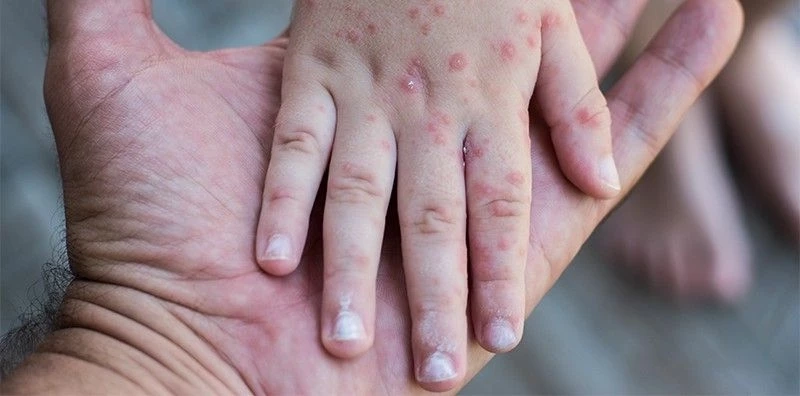 นักไวรัสวิทยาแนะตรวจหาเชื้อ "ฝีดาษลิง" ด้วยการ “swab” เหมือนตรวจโควิด