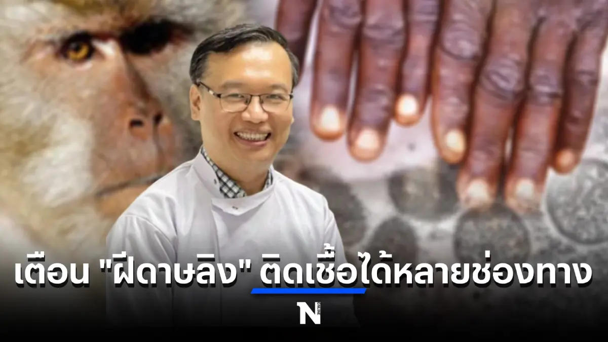 ทำความเข้าใจ โรคฝีดาษลิง ติดเชื้อได้กี่ช่องทาง รู้ทันโรค ช่วยลดความเสี่ยง