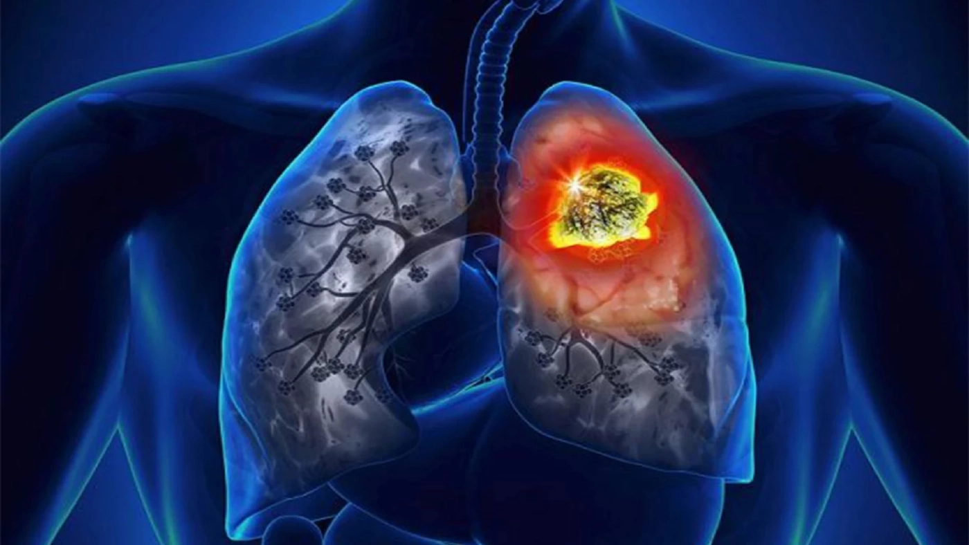 จับสัญญาณ "มะเร็งปอด" โรคร้ายที่คร่าชีวิต "ครูมืด" และคนดังไปมากมาย