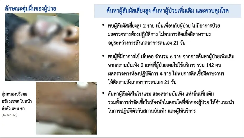 ประสานกัมพูชาสกัด"ฝีดาษลิง"แพร่ คาดชายไนจีเรียมีคนช่วยพาหนี ฝ่าฝืนกม.