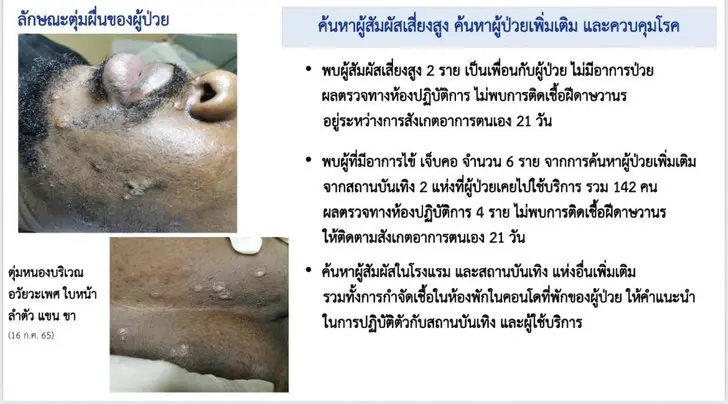 สสจ.ภูเก็ต แถลงข่าวการสอบสวนโรคฝีดาษลิง 