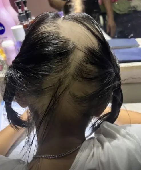 ทุกข์มาก แม่ร้องช่วย "เด็ก 9 ขวบ" ผมร่วมเกือบทั้งหัว หลังฉีดวัคซีนโควิดเข็ม 2