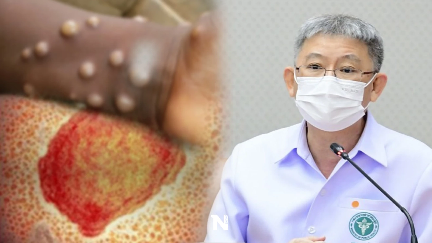 ด่วน! สธ.ยืนยันพบผู้ป่วยฝีดาษลิง รายที่ 4 เป็นผู้หญิงใกล้ชิดต่างชาติ