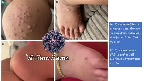 รู้จัก “ไข้หวัดมะเขือเทศ” หลังพบการระบาดในอินเดีย