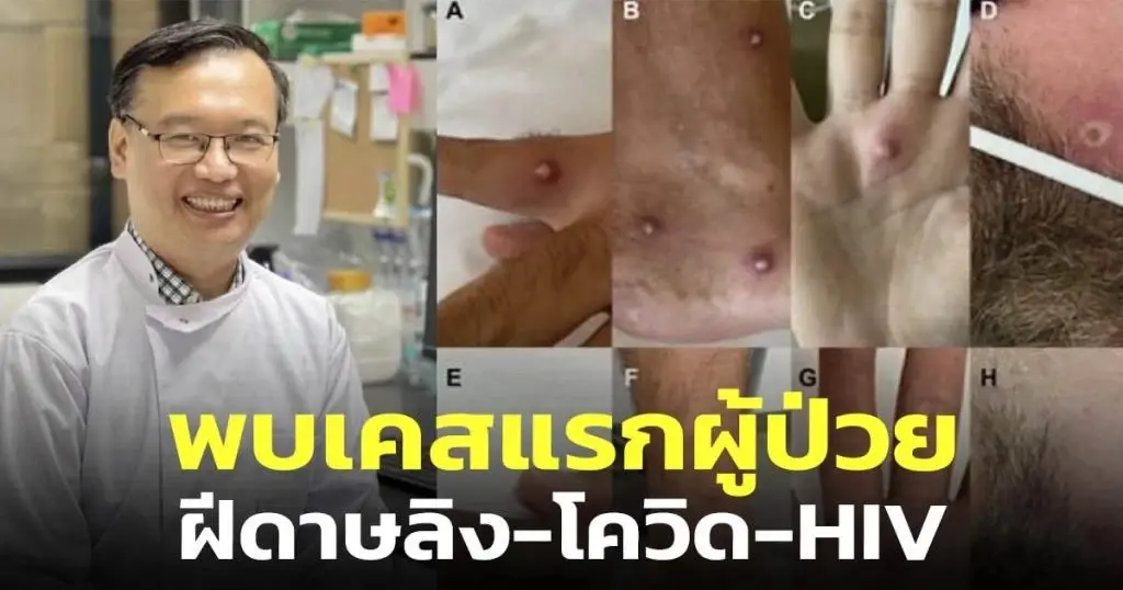 ตะลึง! เปิดเคสพบผู้ป่วย "โควิด-ฝีดาษลิง-HIV" ในคนๆเดียว อันตรายแค่ไหน?