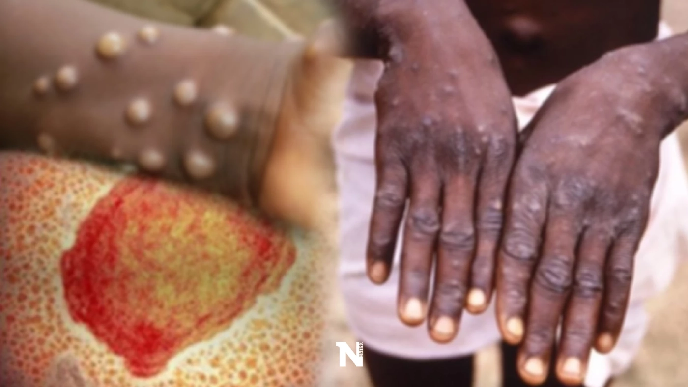 หมอยง เปิดข้อมูล "ฝีดาษลิง" เหตุใดตุ่มจึงขึ้นบริเวณอวัยวะเพศ และป้องกันยาก