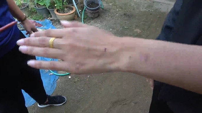 สภาพบาดแผล น.ส.ฟารีด้า อุสนุน 22 ปี เหยื่อจากลิงอันพาล