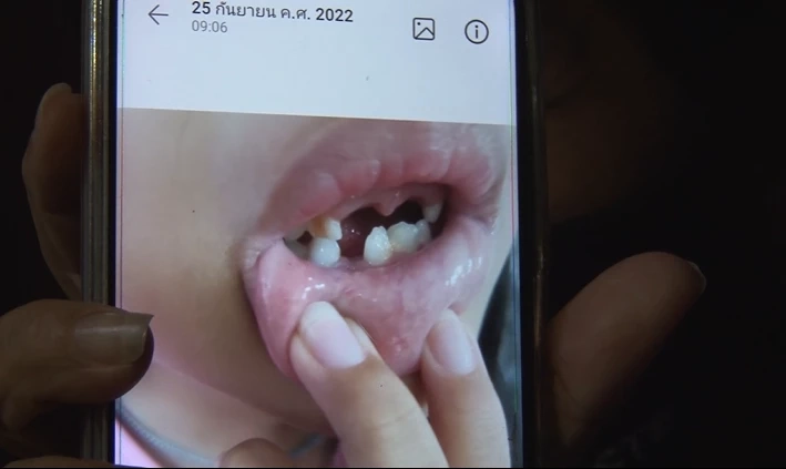 ภาพหลักฐานที่ยายอ้างว่าหลานถูกทำร้าย