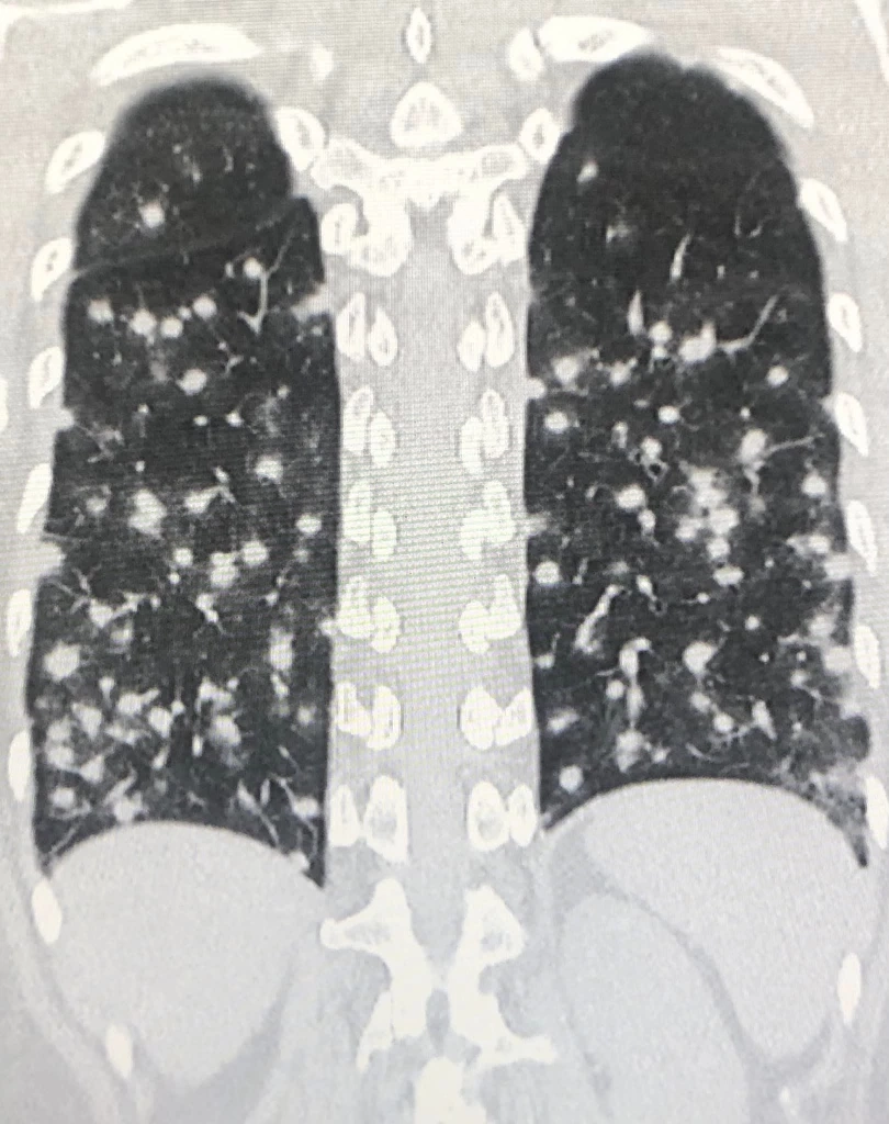 โซเชียลช็อก ชมค้างคาวในโพรงต้นไม้ เจอเชื้อราในปอด แพทย์ชี้ โรคฮีสโตพลาสโมสิส