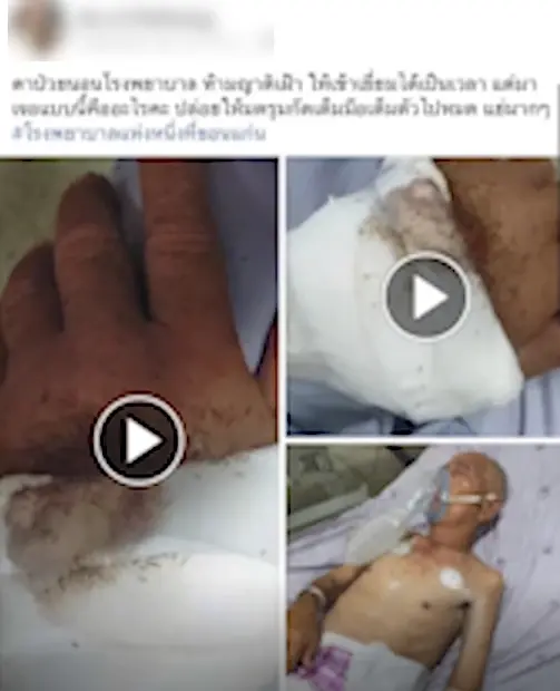 โวย “รพ.ดัง” ปล่อยมดเป็นรังรุมตอมตามตัวผู้ป่วย อ้างพยาบาลไม่สนใจ (มีคลิป)