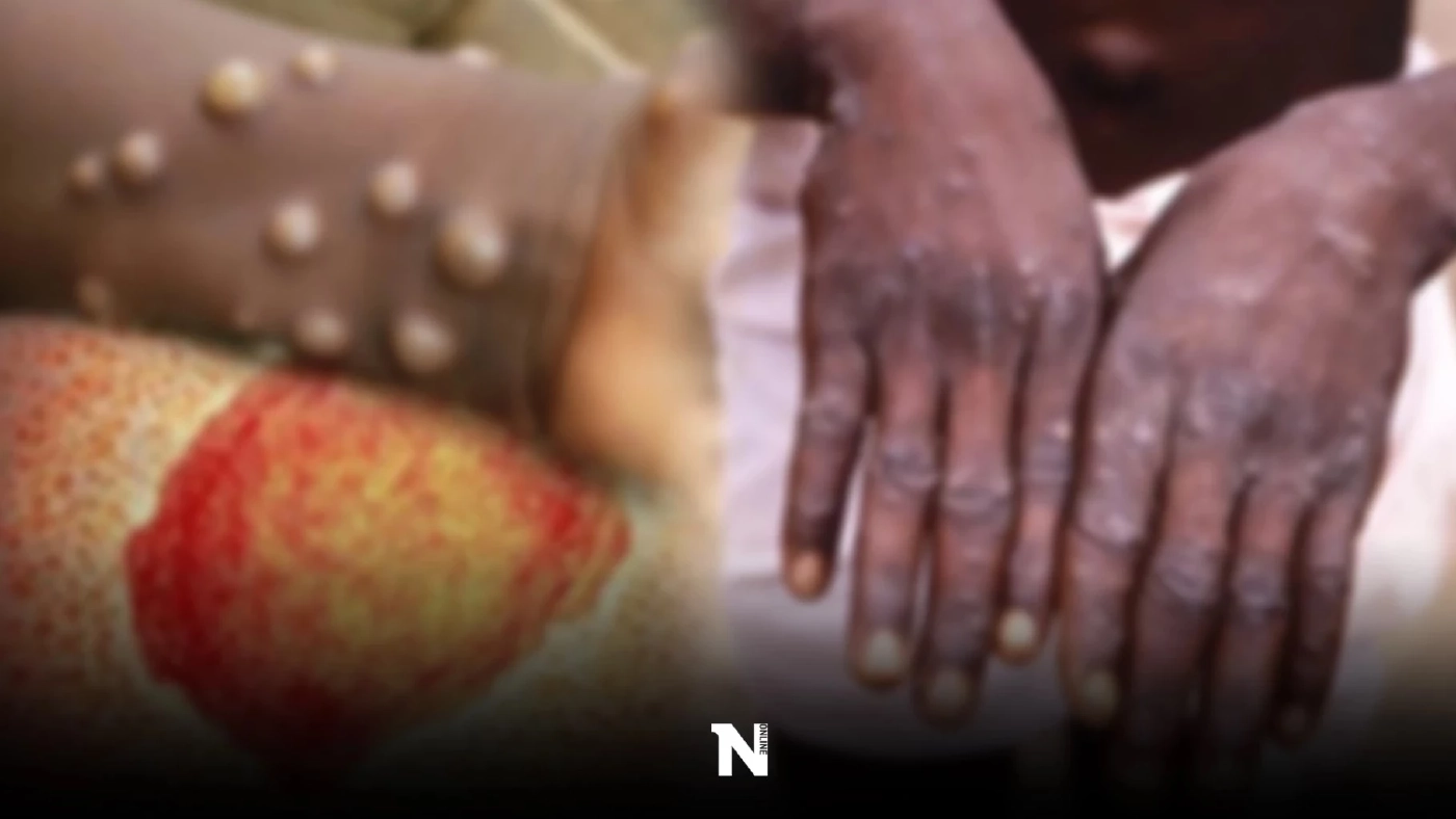 อาการฝีดาษลิง