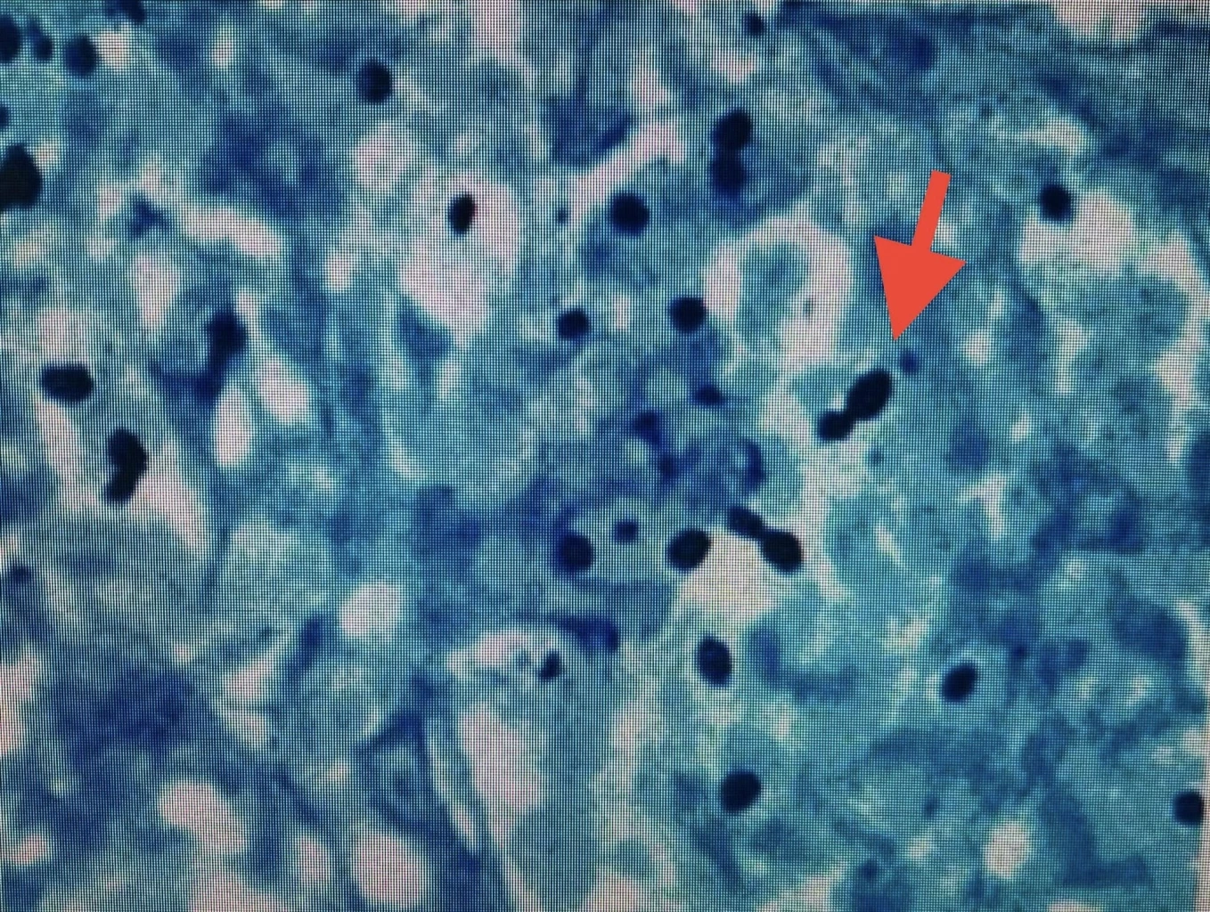 โซเชียลช็อก ชมค้างคาวในโพรงต้นไม้ เจอเชื้อราในปอด แพทย์ชี้ โรคฮีสโตพลาสโมสิส