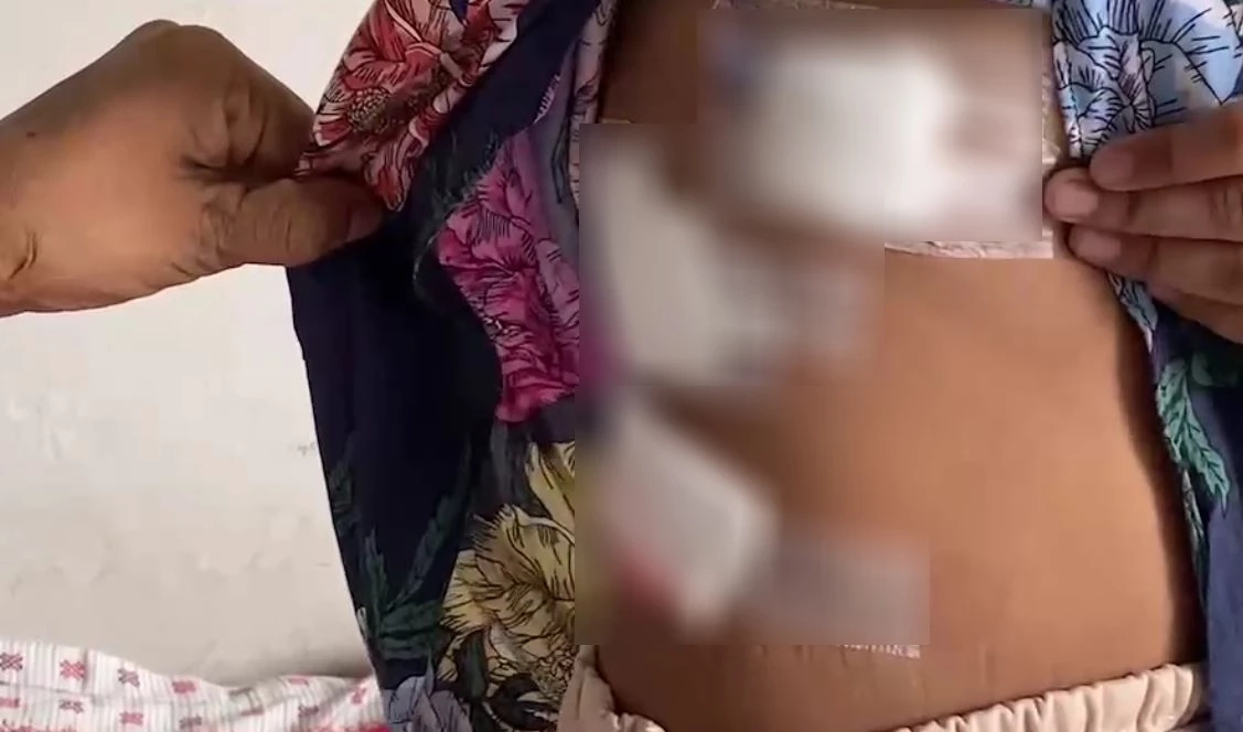 เด็กหญิง 9 ขวบ ถูกสุนัขจรจัดรุมกัด