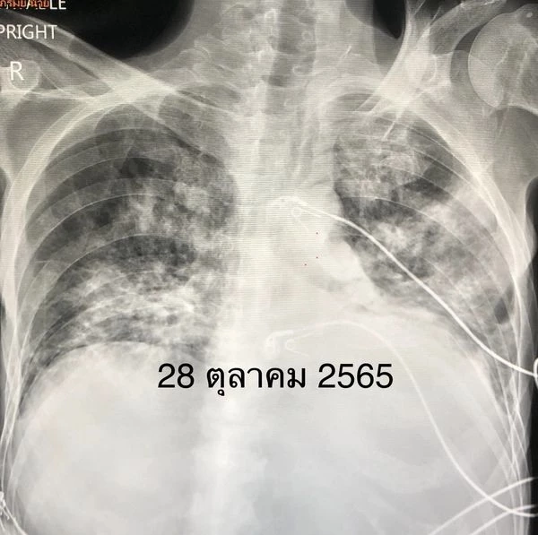 แพทย์ดังยกเคส วัคซีนโควิด ช่วยชีวิตคนเป็นมะเร็งเม็ดเลือดขาว กลุ่ม 608 รีบฉีดวัคซีนด่วน